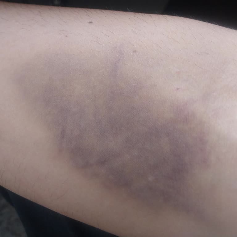 Kan Bağışı Sonrası Şişlik Ve Morarma İçin Açıklama Talebi