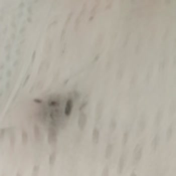 Prima Bebek Bezinde Görülen Siyah Maddeler Nedeniyle Sağlık Endişesi