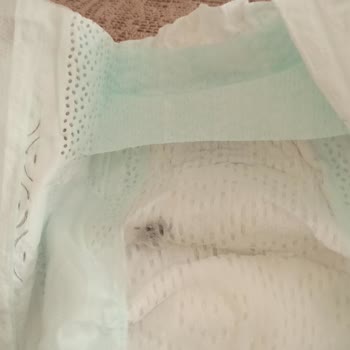 Prima Bebek Bezinde Görülen Siyah Maddeler Nedeniyle Sağlık Endişesi