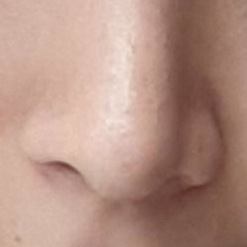 Op. Dr. Erdem Çağlar Hem Sağlık Hem Estetik Açıdan Olumsuz Sonuçlanmış Bir Ameliyat