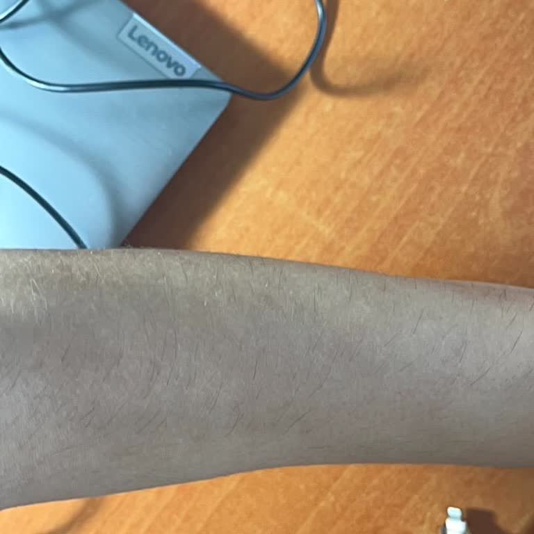 Lazer Epilasyon Sonuç Vermedi, Ücretin Yarısı İade Talebi