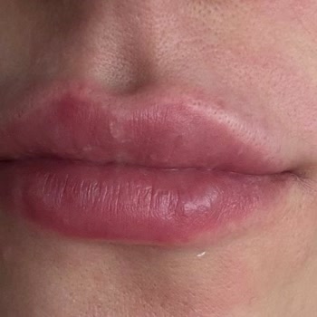 Eksik Bilgilendirme Nedeniyle Biber Aromalı Sephora Glossu Dudaklarda Yanık Ve Deformasyona Yol Açtı
