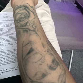 Söz Verilen Dövme Silme İşleminde Hiç Sonuç Alınmadı Ve Ücret İadesi Talebi