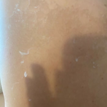 Ciltte Soyulma Yaşadık Ürün İadesi Ve Özür Talebi