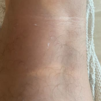 Ciltte Soyulma Yaşadık Ürün İadesi Ve Özür Talebi