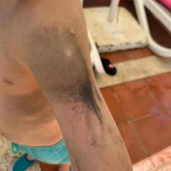 Deniz Kolluğu Boyası Çocuğumun Kolunda Şiddetli Tahrişe Yol Açtı
