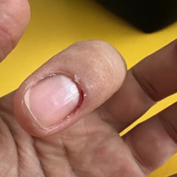 Hamile Kadına Yapılan Manikürde 8 Parmak Kesildi Ve Steril Olmadığı Şüphesi