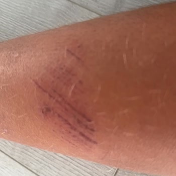 Onvo Scooter’da Tekrarlayan Arızalar Ve Çocuk Yaralanması Nedeniyle İade Talebi