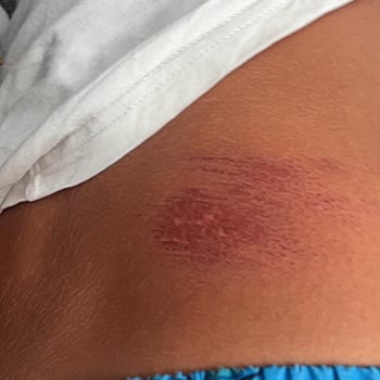 Onvo Scooter’da Tekrarlayan Arızalar Ve Çocuk Yaralanması Nedeniyle İade Talebi