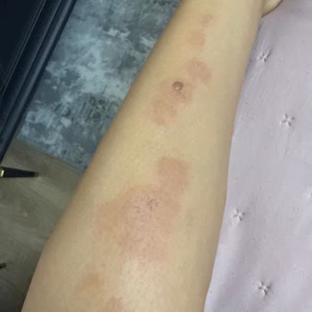 Novar Alsancak’ta Lazer Epilasyon Sonrası Ağır Yanık Ve İade Talebi