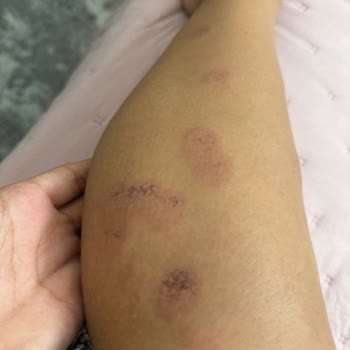 Novar Alsancak’ta Lazer Epilasyon Sonrası Ağır Yanık Ve İade Talebi