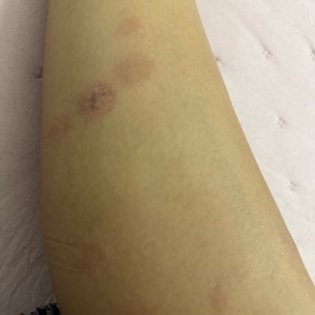 Novar Alsancak’ta Lazer Epilasyon Sonrası Ağır Yanık Ve İade Talebi
