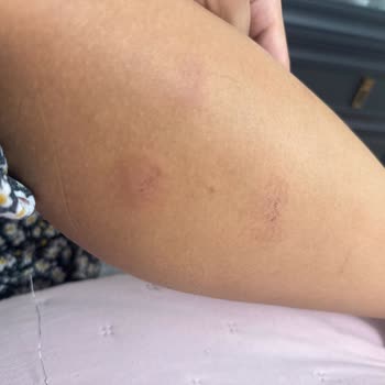 Novar Alsancak’ta Lazer Epilasyon Sonrası Ağır Yanık Ve İade Talebi