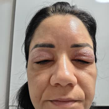 Göz Kapak Germe Sonrası Şiddetli Şişlik Ve Verilen İade Sözünün İhlali