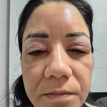 Göz Kapak Germe Sonrası Şiddetli Şişlik Ve Verilen İade Sözünün İhlali