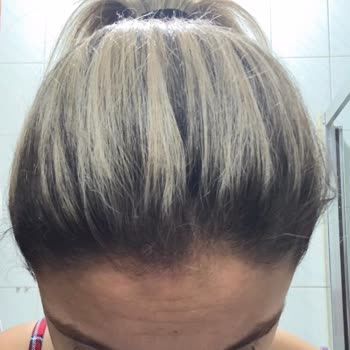 Aşırı Fiyatlı Ombre İşlemi Sonrası Saç Yanması, Kopması Ve Renk Hatası