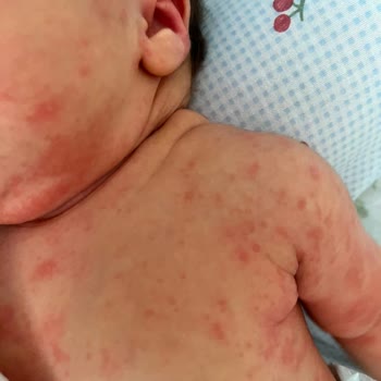 Aptamil Formülünün Bebekte Alerjik Reaksiyonuna Sebep Olması Ve İade Talebi