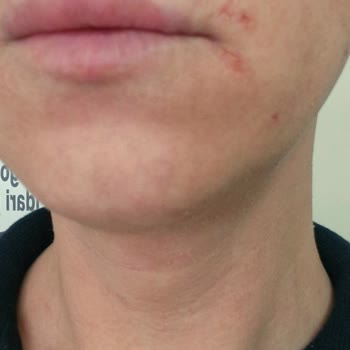 Dr. Merve Bingöl Cildimde Hiçbir Olumlu Değişiklik Olmadı
