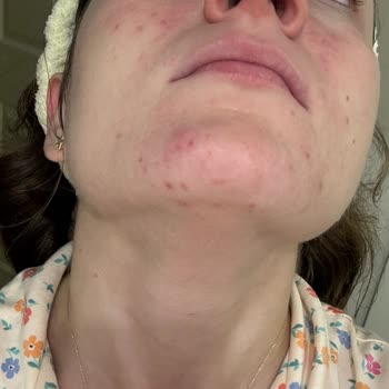 Bilgi Eksikliğiyle Anestezi Uygulaması Sonrası Epilepsi Atağı Ve İzinsiz Fotoğraf Kullanımı