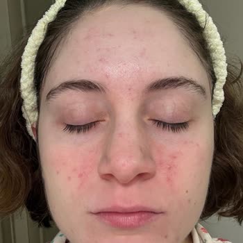 Bilgi Eksikliğiyle Anestezi Uygulaması Sonrası Epilepsi Atağı Ve İzinsiz Fotoğraf Kullanımı