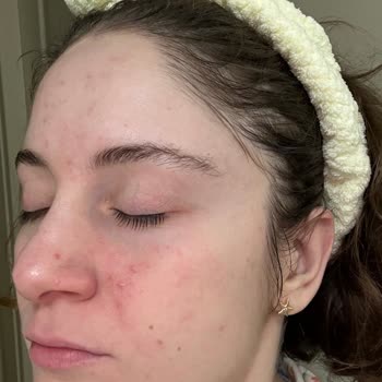 Bilgi Eksikliğiyle Anestezi Uygulaması Sonrası Epilepsi Atağı Ve İzinsiz Fotoğraf Kullanımı