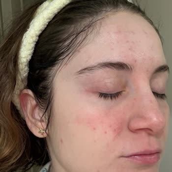 Bilgi Eksikliğiyle Anestezi Uygulaması Sonrası Epilepsi Atağı Ve İzinsiz Fotoğraf Kullanımı