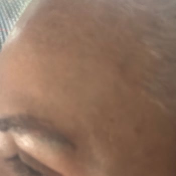 Eksik Kaş Ekimi Ve Çözüm Sunulmayan Hizmetten Ücret İadesi Talebi