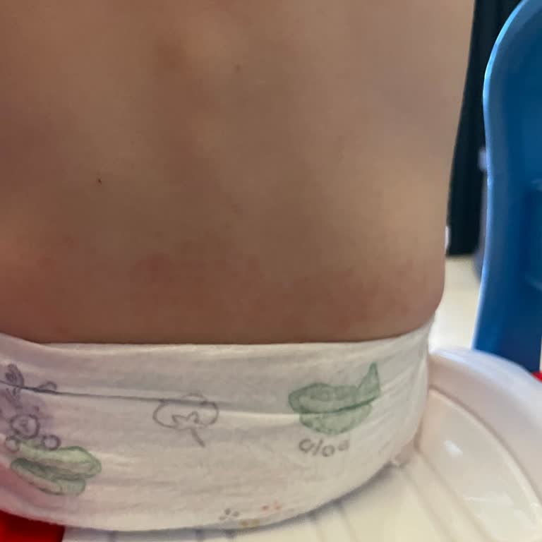 Pampers Prima Aktif Bebek Bezinde Bel Kızarıklığı Ve Alerji Sorunu