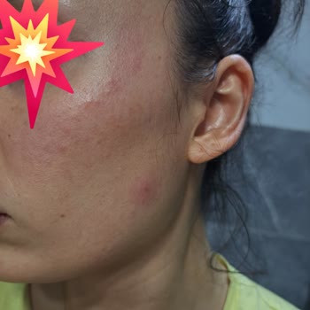 CeraVe Foaming Cleanser Caused Burning Redness and Breakouts