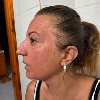 Yves Rocher Pure Menthe Temizleme Jelinde Şiddetli Yanma Ve Kızarıklık