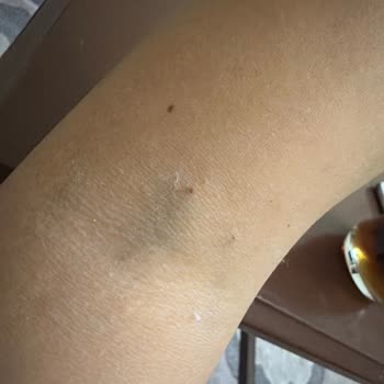 Acilde Damar Açma Hatası Ve Kaba Tutum