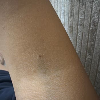 Acilde Damar Açma Hatası Ve Kaba Tutum