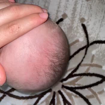 SMA Bebek Mamasına Bağlı Cilt Reaksiyonu Ve İade Talebi