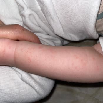 SMA Bebek Mamasına Bağlı Cilt Reaksiyonu Ve İade Talebi