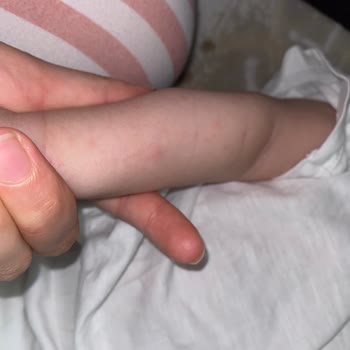 SMA Bebek Mamasına Bağlı Cilt Reaksiyonu Ve İade Talebi