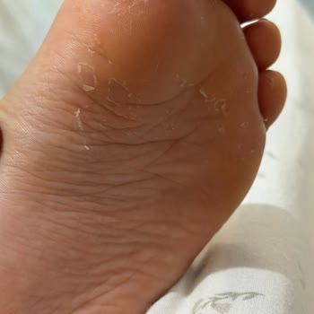 Birkenstock Sandaletinde Oluşan Koku Ve Deri Soyulması Çocuğumun Sağlığını Tehdit Ediyor