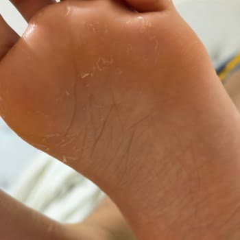Birkenstock Sandaletinde Oluşan Koku Ve Deri Soyulması Çocuğumun Sağlığını Tehdit Ediyor