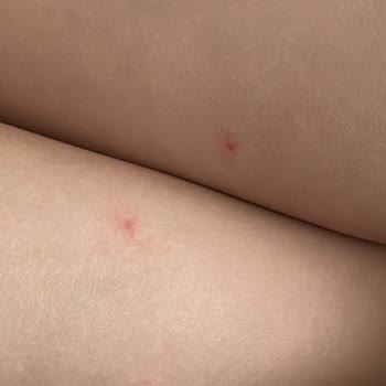 Lazer Epilasyonunda Aşırı Isı Ve Sorumluluk Reddi