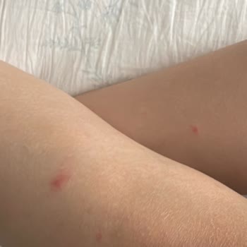 Lazer Epilasyonunda Aşırı Isı Ve Sorumluluk Reddi
