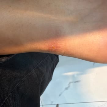 Topuk Yaralanması Nedeniyle New Balance Ayakkabının İadesi Ve Değişimi Talebi