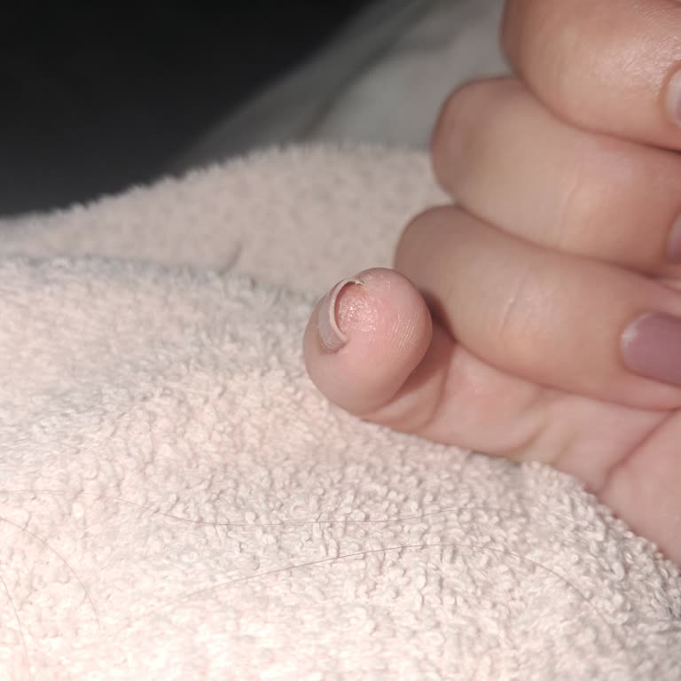 Honey Nail’da Protez Tırnak Sonrası Alerjik Kabarcıklar Ve Duyarsız Hizmet