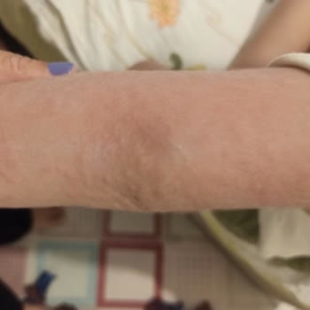 Otobüs Koltuklarındaki Tahta Kurusu Çocuğumu Isırdı Ve Sağlığını Tehdit Etti