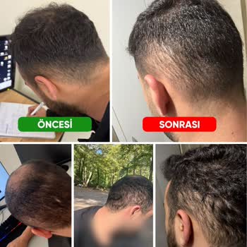 Fixhair Clinic'te Hatalı Saç Ekimi Ve Donör Bölge Tahribatı