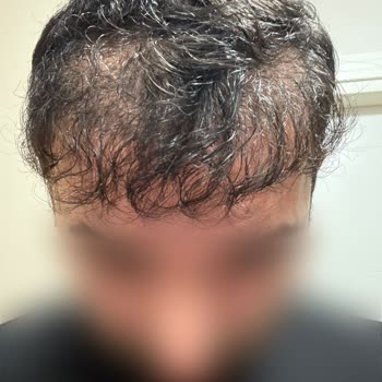 Fixhair Clinic'te Hatalı Saç Ekimi Ve Donör Bölge Tahribatı