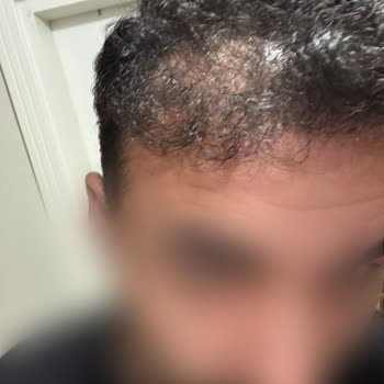 Fixhair Clinic'te Hatalı Saç Ekimi Ve Donör Bölge Tahribatı