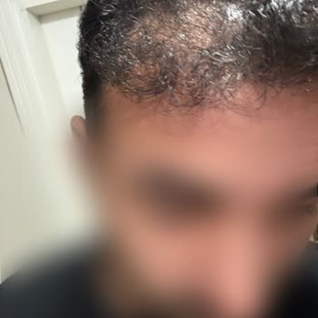 Fixhair Clinic'te Hatalı Saç Ekimi Ve Donör Bölge Tahribatı