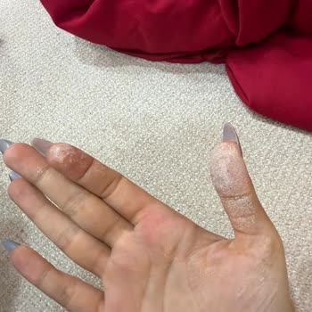Vanish Kosla Oxi Action Kullanımında Şiddetli Cilt Yanması Ve Soyulma