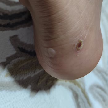 Deriden Sandaletlerde Ayak Yarası Ve Geri Gönderim Sürecinde İletişimsizlik