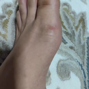 Deriden Sandaletlerde Ayak Yarası Ve Geri Gönderim Sürecinde İletişimsizlik