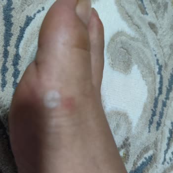 Deriden Sandaletlerde Ayak Yarası Ve Geri Gönderim Sürecinde İletişimsizlik